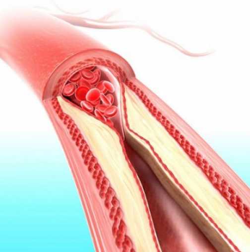 Кардиохирург : Истинската причина за сърдечносъдовите болести въобще не е в холестерола, а в ... 