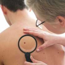 10 неща, които трябва да знаете за рака на кожата