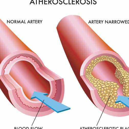 Атеросклероза - профилактика и лечение