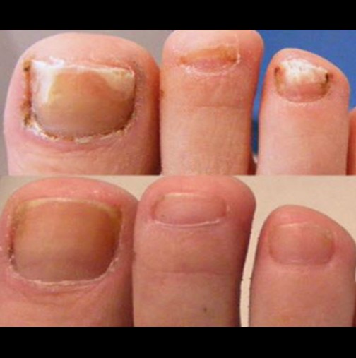 4-те най-ефективни съвета за премахване на гъбичките по ноктите в домашни условия!