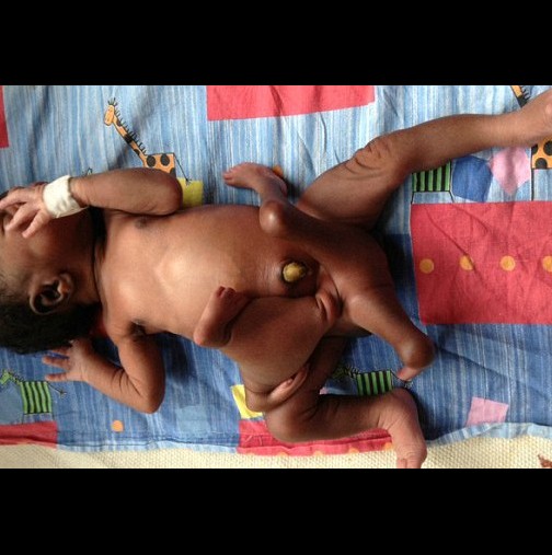 Роди се бебе с 8 крайника в Индия, смятат го за бог