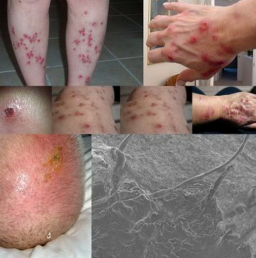 Паника: Нова болест на Балканите, обрив, зачервяване, странни влакна излизат от кожата 
