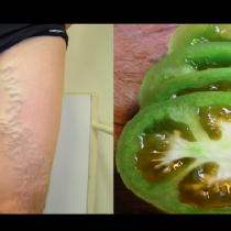 Лечение на разширени вени със зелени домати