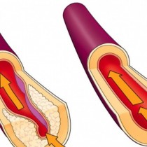 Атеросклероза признаци и как да се предпазим