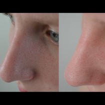 Как завинаги да премахнете малките черни точки от носа?