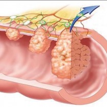 Удължават живота на болни от рак на дебелото черво 2 пъти!