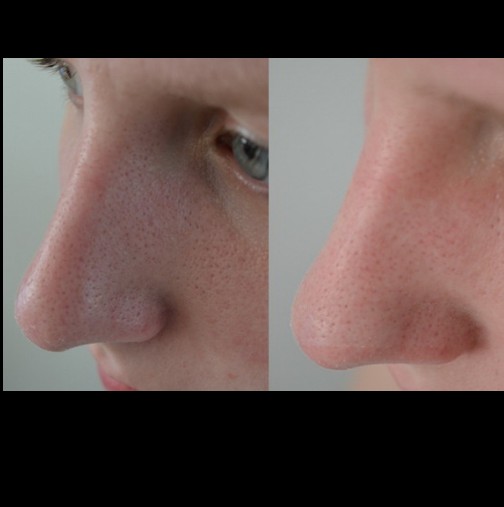 Как да премахнете черните точки от носа си незабавно? Безотказан метод 