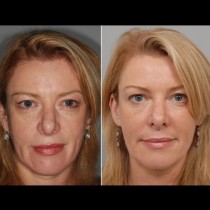 Всяка дама трябва да знае тези 5 трика, с които ще изтрие всички бръчки по лицето си и ще изглежда с 10 години по-млада