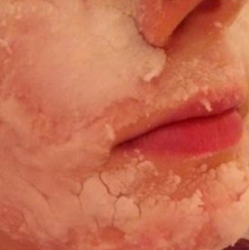 Трик, с който кожата ви ще свети: Почистете черните точки от лицето за 10 минути