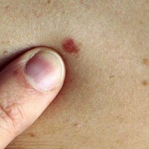 Защо бенките по кожата не се превръщат в ракови тумори 
