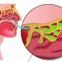 Как да облекчим инфекция на синусите за 20 секунди
