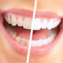 Искате ли бели зъби като от реклама? Смесете следните съставки, които имате у дома