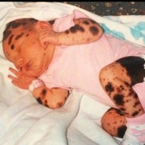 Очарователна история: Това бебе е било покрито със стотици петна, а сега 19 години по-късно вижте как изглежда (Снимки)