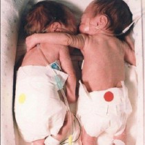 Тези близначки държаха света в напрежение: Тя сложи ръка около умиращата си сестричка. Никой не очакваше това, което се случи после ...