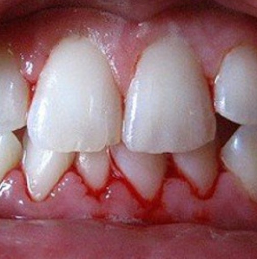 Ако ви кървят венците, това е сигнал за тревога, който не бива да пренебрегвате!