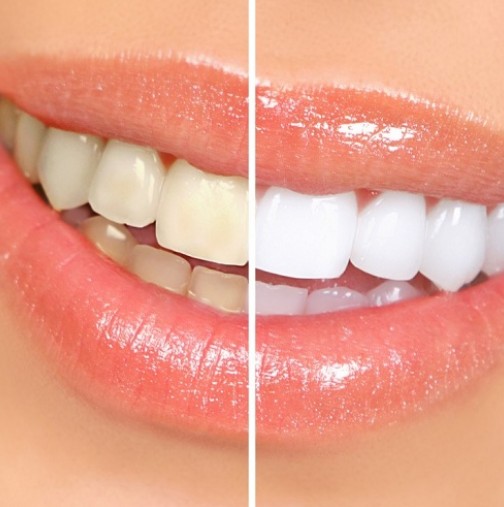 Бели зъби като от реклама: Смесете тези две съставки и ще станете свидетели на чудо!!!