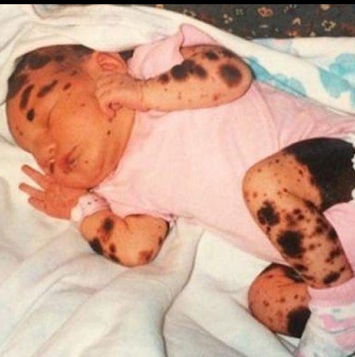 Очарователна история: Това бебе е било покрито със стотици петна, а сега 19 години по-късно вижте как изглежда (Снимки)