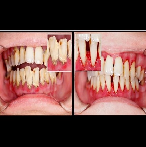 Това е най-простият начин да отстраните зъбен камък, плака и да почистите устата си от бактерии