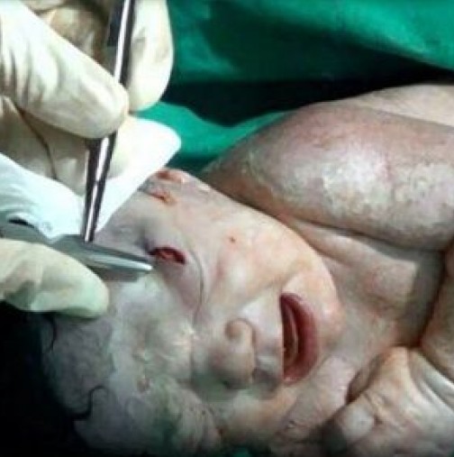Лекари изродиха новородено със забит шрапнел в главата 