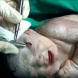 Лекари изродиха новородено със забит шрапнел в главата 