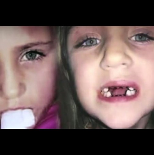 Зъболекар-чудовище вади вместо 1, седем зъба и обезобразява малки деца!