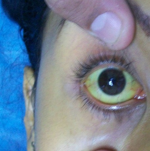 Кожата и очите ѝ започнаха да пожълтяват, но когато лекарите казаха, каква е причината, тя изпадна в шок!