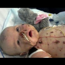Само на 11 месеца тъканите й почнали да гният! Преминала през същинският ад и ето как изглежда днес! (Снимки)