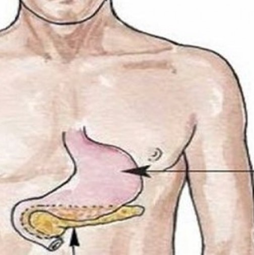 Бързо и ефективно унищожете бактерията в стомаха - Страхотно е и срещу хеликобактер