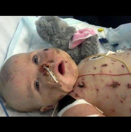 Само на 11 месеца тъканите й почнали да гният! Преминала през същинският ад и ето как изглежда днес! (Снимки)