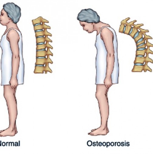 Вижте, дали сте предразположени към остеопороза-Тест-проверка за костна плътност
