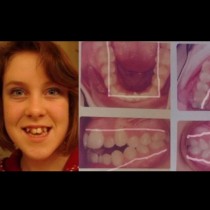 В училище я наричали чудовище, заради зъбите ѝ, а днес изглежда така