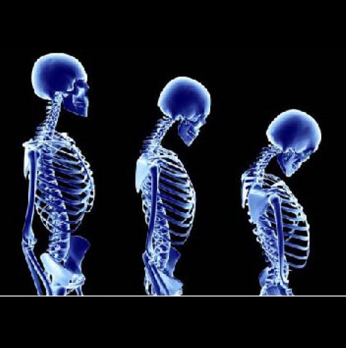 Уникално полезен тест, който ще ви покаже каква е вашата костна плътност и дали сте предразположени към остеопороза?