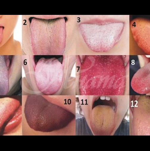 Състоянието на езика подсказва за болестите ни - разпознайте своя език по снимката!
