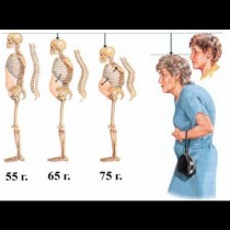 Как да проверите дали имате предразположеност към остеопороза