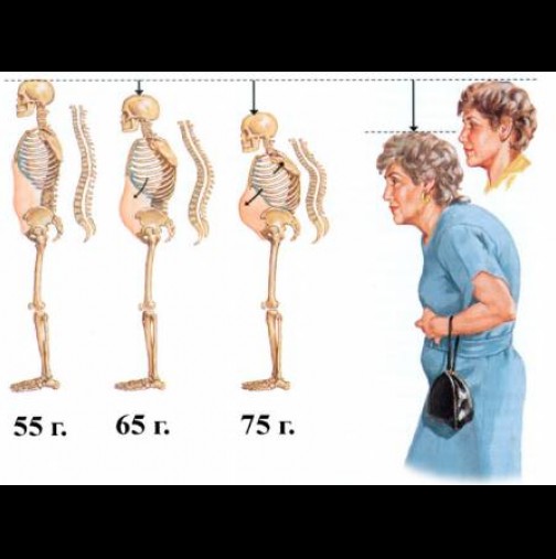 Как да проверите дали имате предразположеност към остеопороза