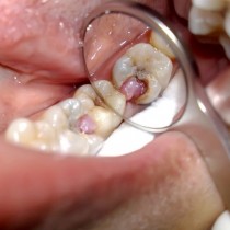Как да премахнете зъбоболът само за секунди? Трик, който рано или късно ще ви бъде от полза