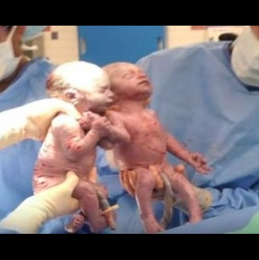 За тях всички чуха- Веднъж на 10 000 бременности се случва-Ето как изглеждат днес близначките, които се родиха хванати за ръце
