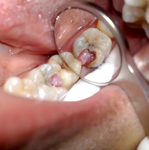 Как да премахнете зъбоболът само за секунди? Трик, който рано или късно ще ви бъде от полза