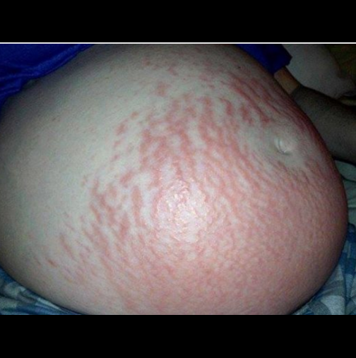 Жена, която ще остане запомнена с алергията към собствената си бременност!