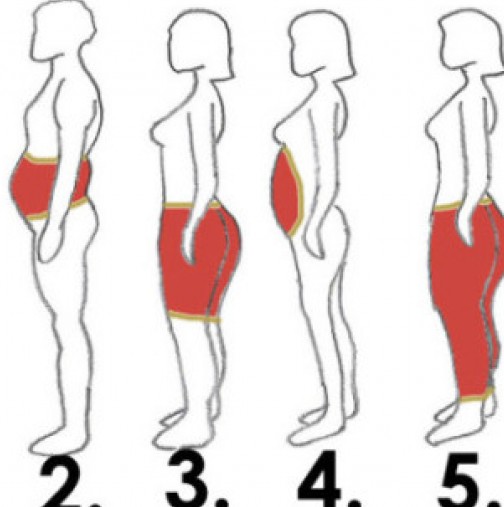 При наднормено тегло според различните области на тялото- 1-Горната част на тялото-липса на физически упражнения, областта на ...