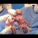 За тях всички чуха- Веднъж на 10 000 бременности се случва-Ето как изглеждат днес близначките, които се родиха хванати за ръце