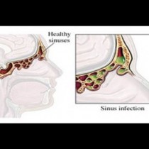 Спасете се от неприятния синузит за броени секунди!