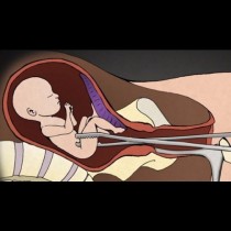 Ужасяващо: Късат части от тялото, чупят главата... Ето какво се случва на бебетата при аборт!