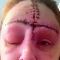 Хорър при раждане! На тази майка ѝ избухнала челото, под което били открити 3 тумора-Вижте как изглеждаше преди