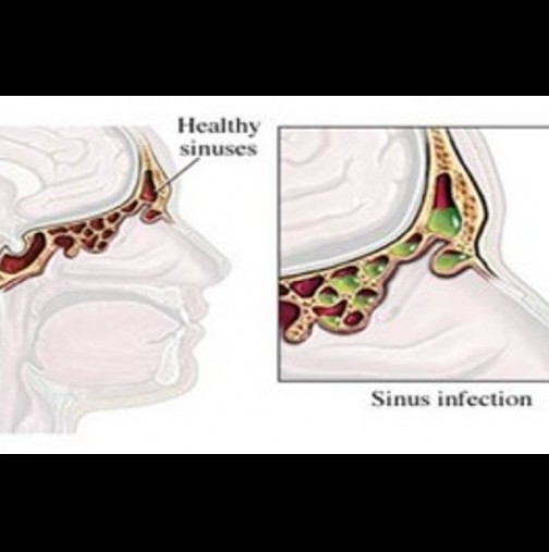 Спасете се от неприятния синузит за броени секунди!