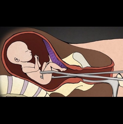 Ужасяващо: Късат части от тялото, чупят главата... Ето какво се случва на бебетата при аборт!