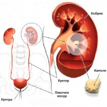 Ето как най- лесно да разберете дали имате камъни в бъбреците?