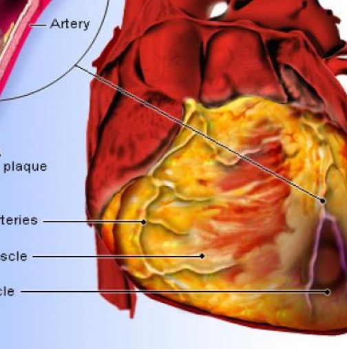 Известен кардиохирург разкри истинските причини за сърдечно-съдовите заболявания-Измамата с холестерола