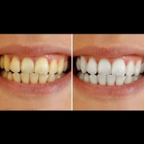 Ето как да премахнете жълтите натрупвания от зъбите си само с една съставка?