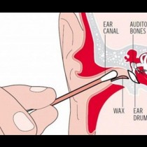 Изхвърлете клечките за уши! Лекар разккри най-ефективния начин за почистване
